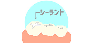 シーラント