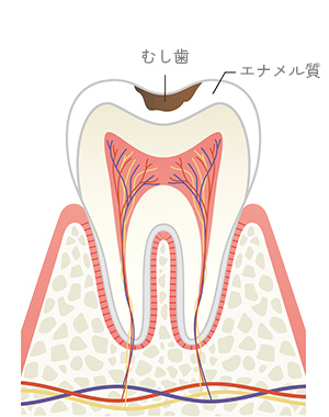 エナメル質う蝕