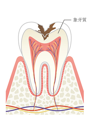 象牙質う蝕