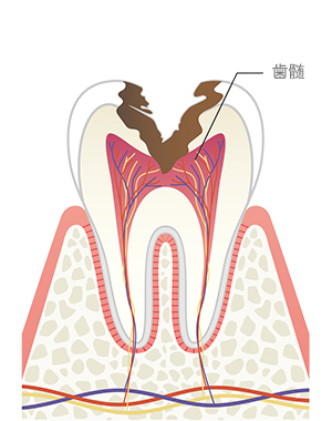 歯髄炎
