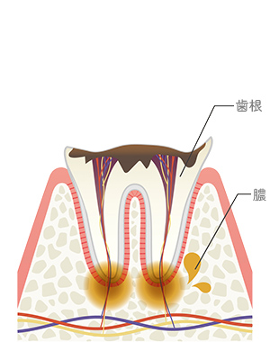 歯冠崩壊