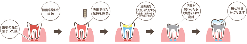根管治療
